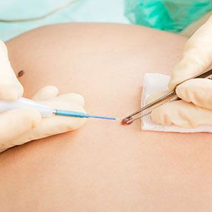 Wart Removal Treatment in Hyderabad